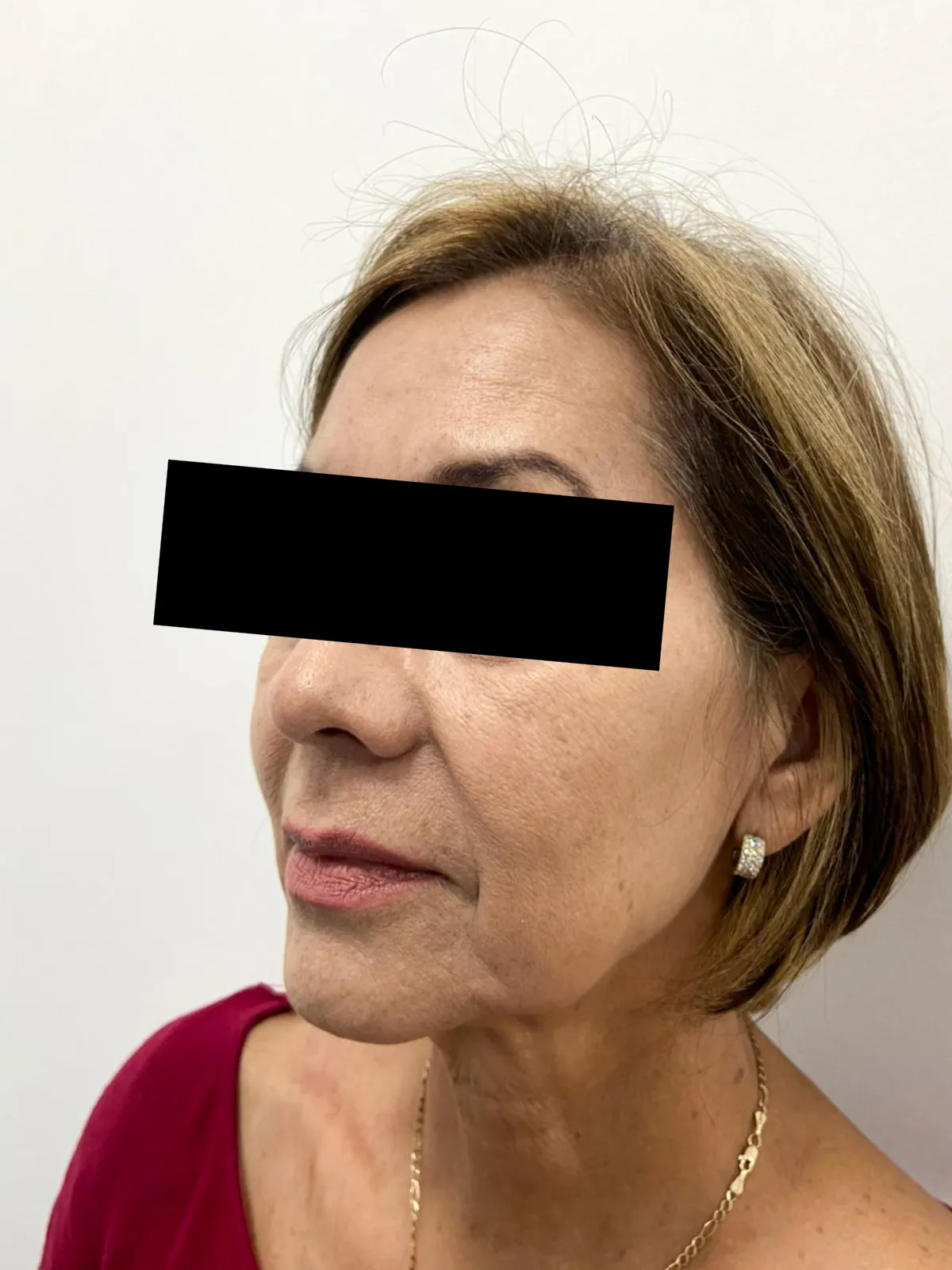 Rejuvenecimiento facial - Antes