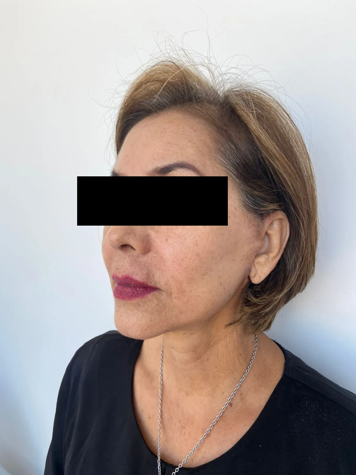 Rejuvenecimiento facial - Después